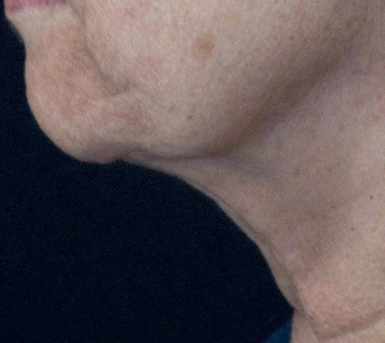 After Fotona 4D · Jawline