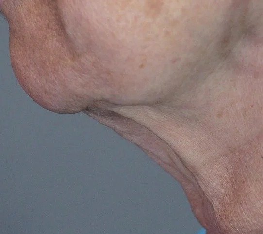 Before Fotona 4D · Jawline
