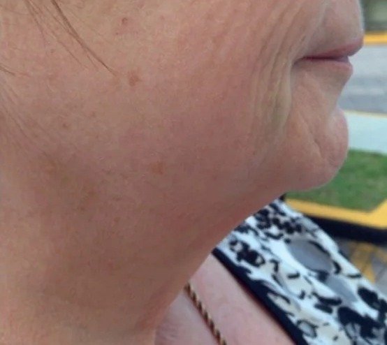 Fotona 4D result: Neck