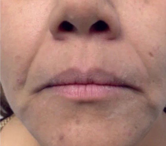 After Fotona 4D · Smile lines