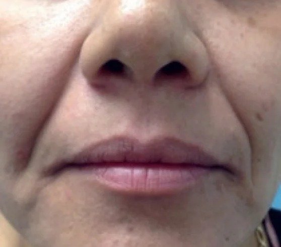 Before Fotona 4D · Smile lines