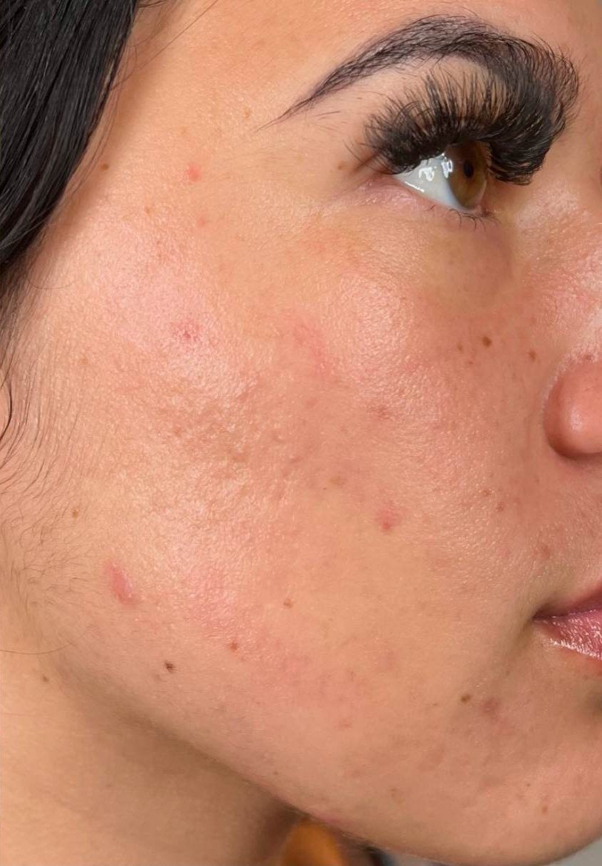 After HydraFacial · Breakouts