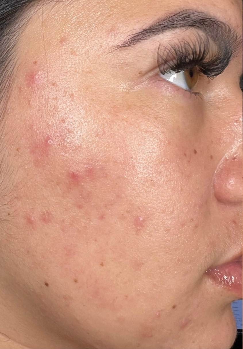Before HydraFacial · Breakouts