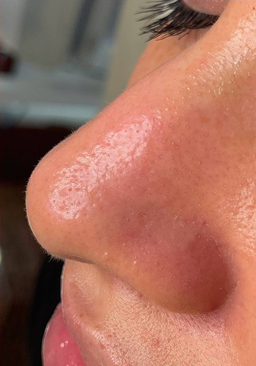 After HydraFacial · Clogged pores