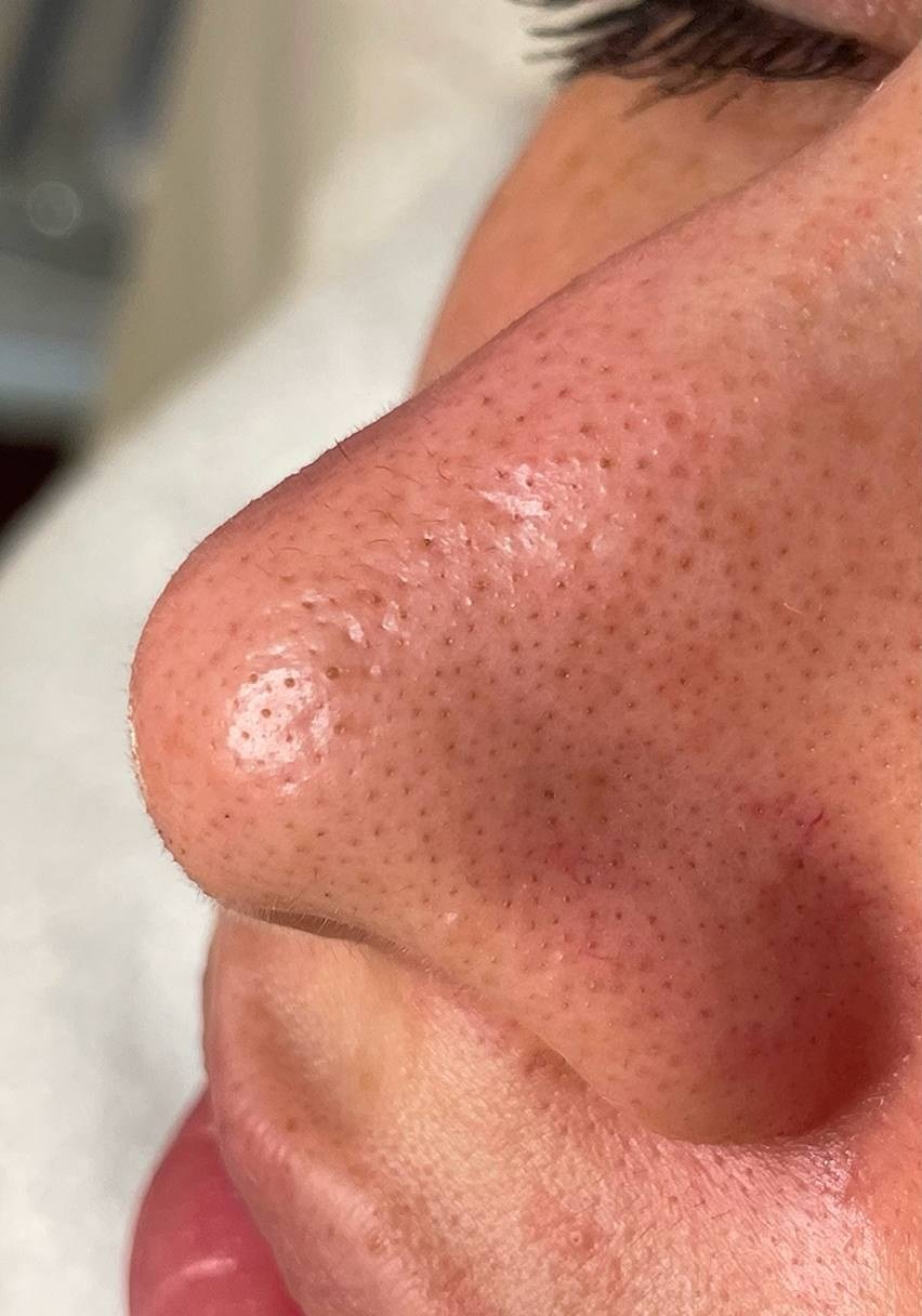Before HydraFacial · Clogged pores
