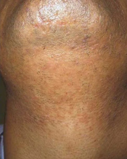 After Laser hair removal · Back