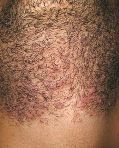 Before Laser hair removal · Back