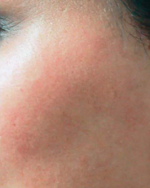 After Laser hair removal · Face