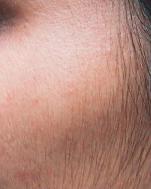 Before Laser hair removal · Face