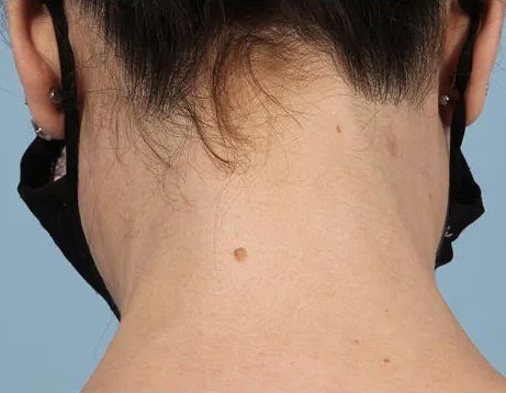 Laser Hair Removal result: Nape of neck