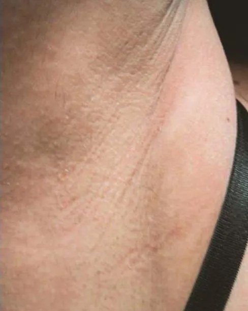 After Laser hair removal · Underarms