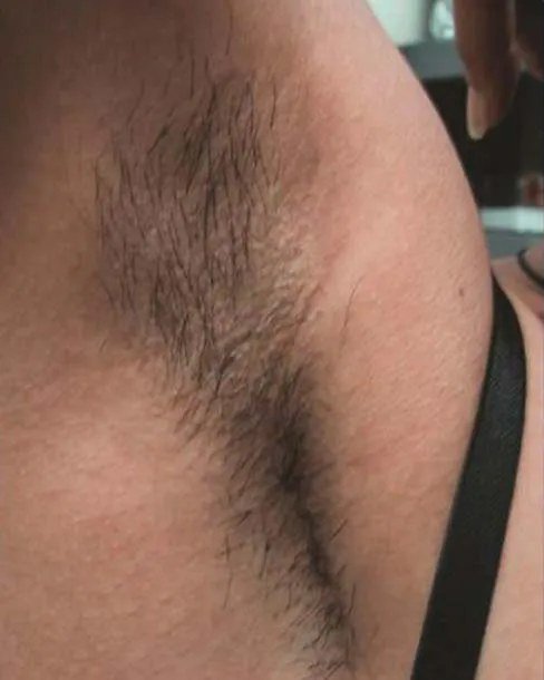 Before Laser hair removal · Underarms