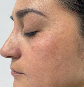 After Melasma · Cheek