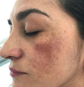 Before Melasma · Cheek
