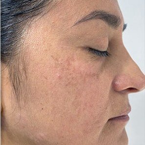 After Melasma · Cheek and temple