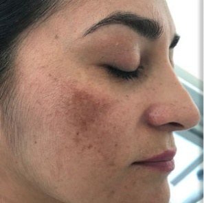 Before Melasma · Cheek and temple