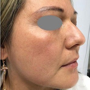 After Melasma · Cheek, side view