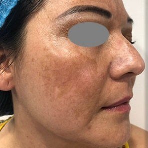 Before Melasma · Cheek, side view