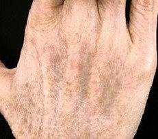 Pigmented Lesions result: Back of the hands