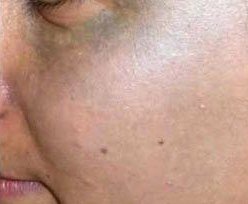 Pigmented Lesions result: Nevus of Ota
