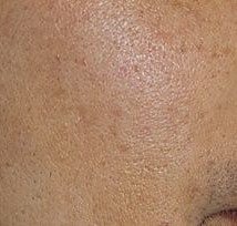 After Pigmented Lesions