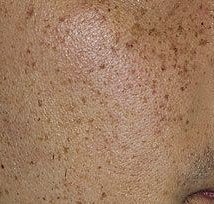Before Pigmented Lesions