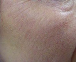Fractional Laser Fotona result: Cheek