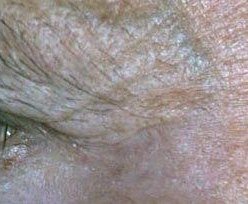 After Fractional Laser Fotona