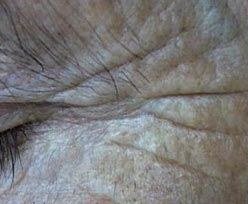 Before Fractional Laser Fotona