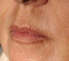 Fractional Laser Fotona result: Around the mouth