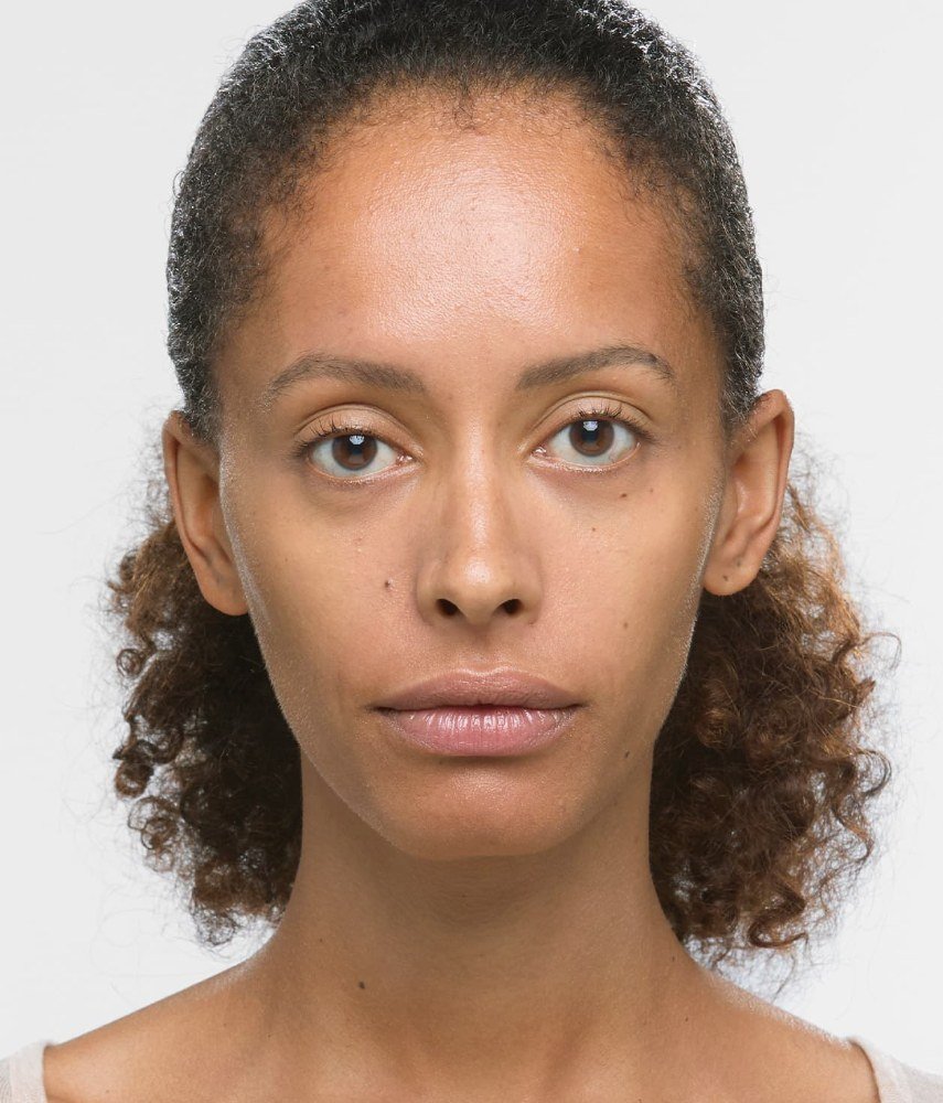 After: Sculptra · full face