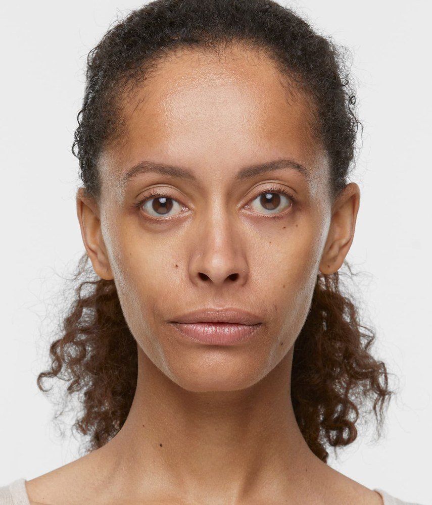Before: Sculptra · full face