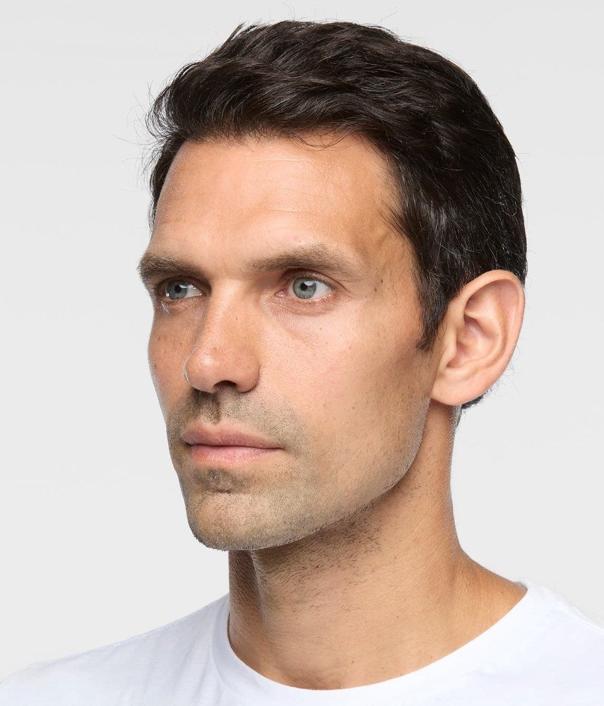 After Sculptra · Men, three-quarter view