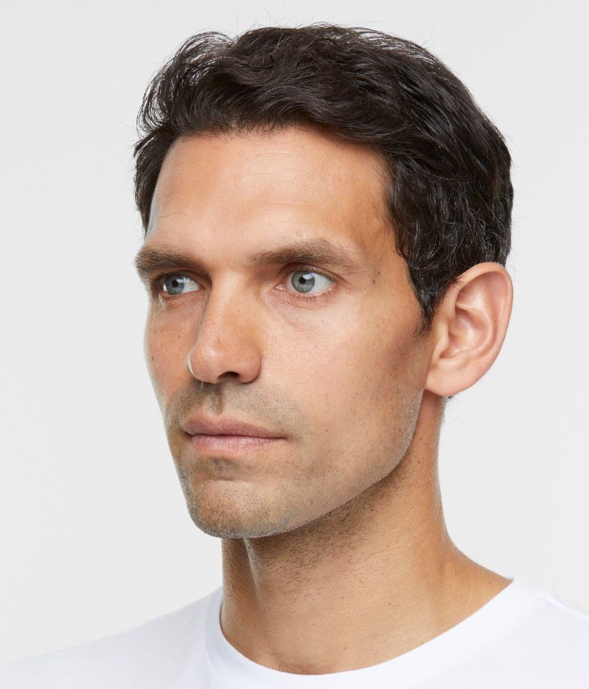 Before Sculptra · Men, three-quarter view