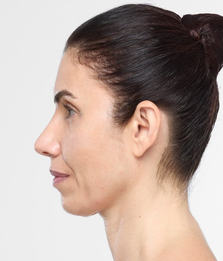 After Sculptra · Jawline, profile