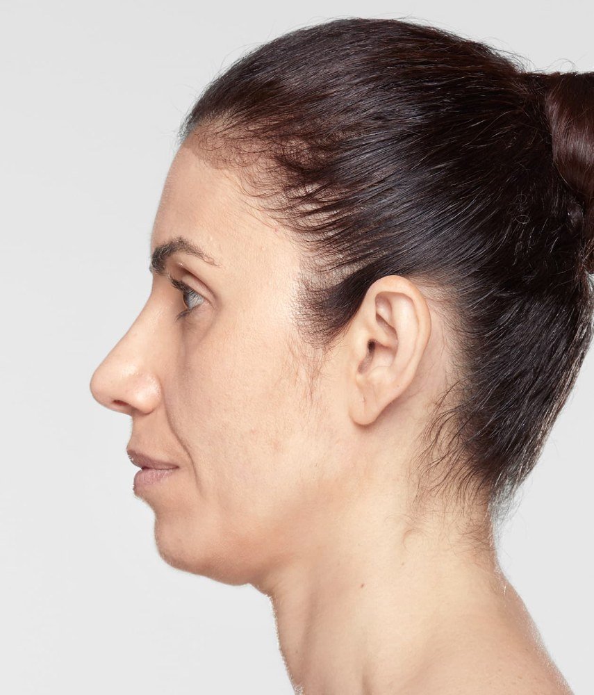 Before Sculptra · Jawline, profile
