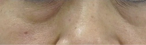 Fotona SmoothEye result: Lower lids