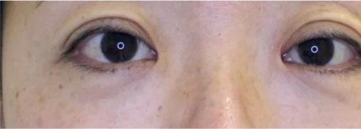 Fotona SmoothEye result: Under the eyes