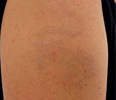 After Tattoo Removal
