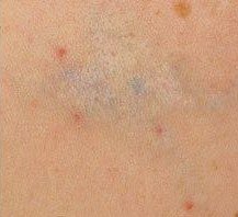 Tattoo Removal result: Shoulder