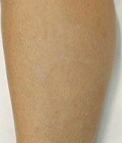 Tattoo Removal result: Lower leg