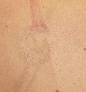 Tattoo Removal result: Wrist