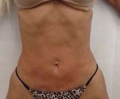 After Fotona TightSculpting