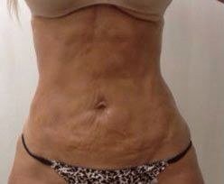 Before Fotona TightSculpting