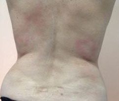 Fotona TightSculpting result: Back