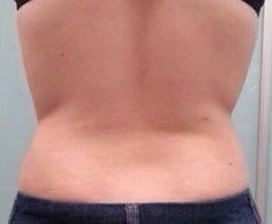 Fotona TightSculpting result: Flanks and lower back