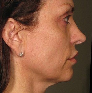 Ultherapy result: Lower face, one year on