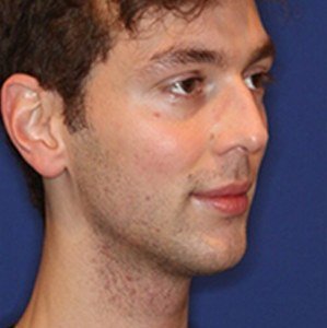 Ultherapy result: Jawline, men