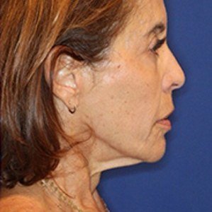 Ultherapy result: Neck and jowls