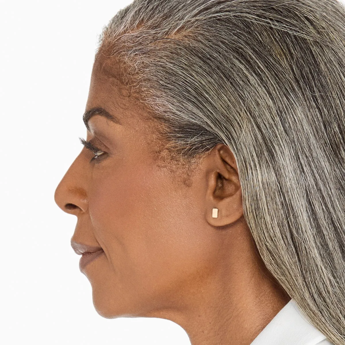After Ultherapy · Chin and neck
